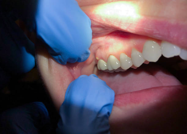 Best Emergency Treatment for Dental Infections or Abscesses in Munroe Falls, OH
